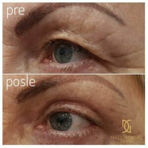blefaroplastika
